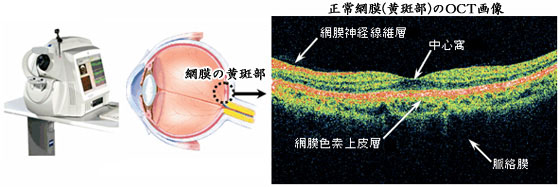 網膜断層解析装置